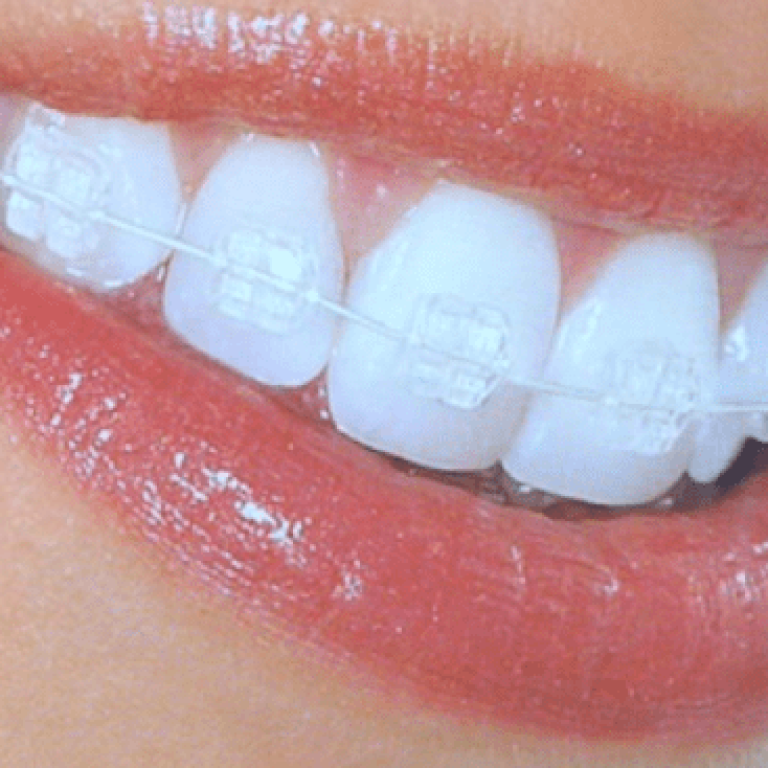 aparat-dentar-ceramic-invisibil-734x367