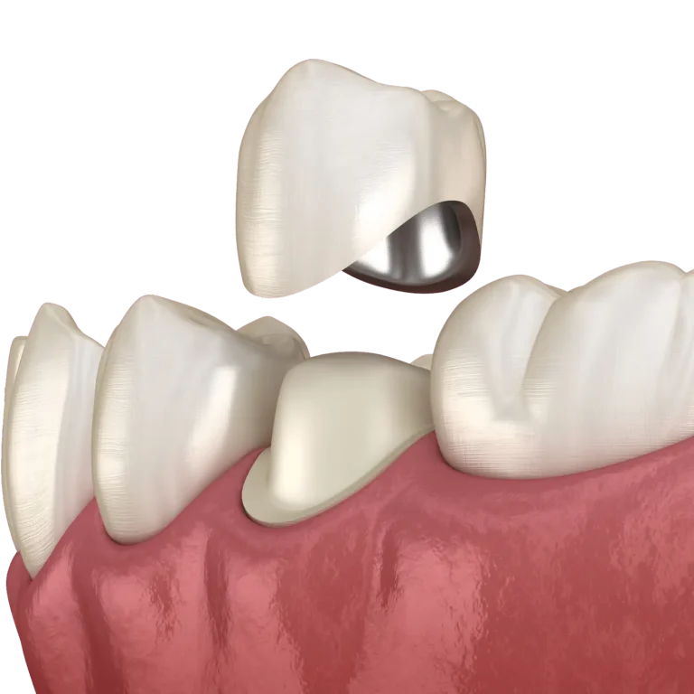 coroana-ceramica-2-2048x1564-2