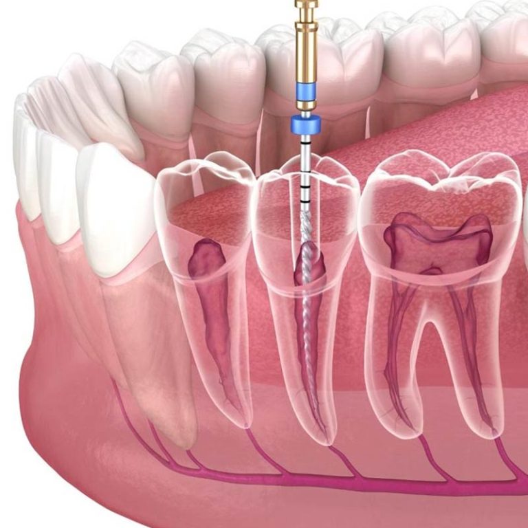 tratamentul-de-canal